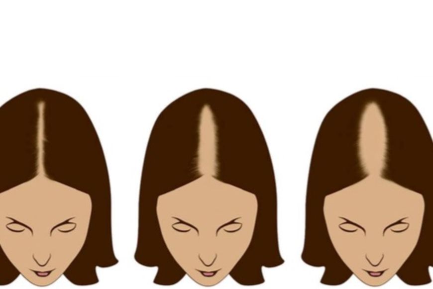 Das Hilft Wirklich Gegen Haarausfall Bei Frauen Artikel Saldo Ch